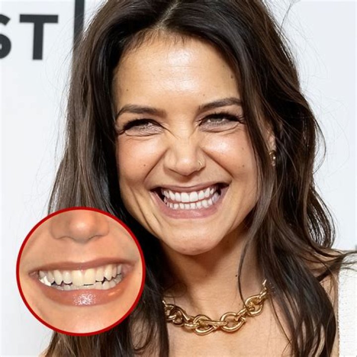 21 Celebrities with Dental Implants, Bridges and Veneers
