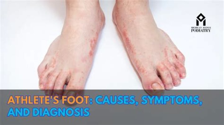Athletes foot Causes, symptoms and treatments General Practice
