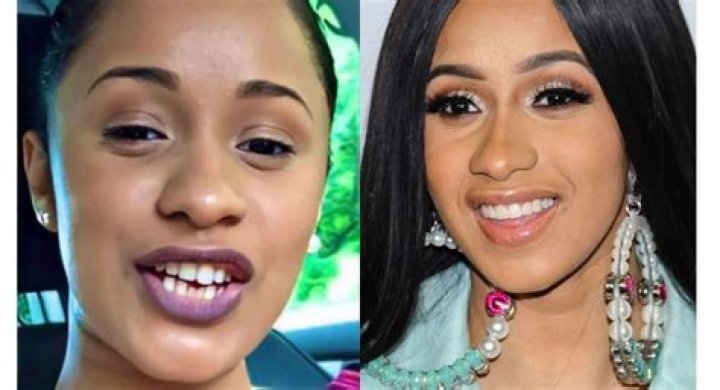 Cardi b teeth before and after cost, surgery, pictures