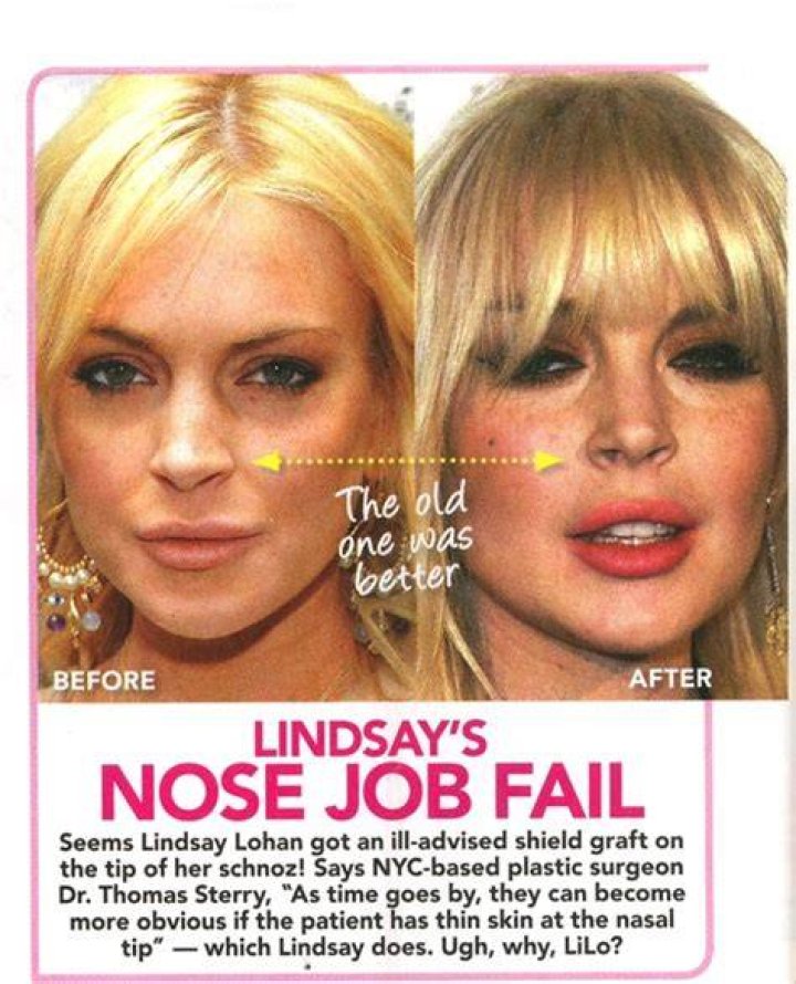 Chatter Busy Lindsay Lohan Nose Job