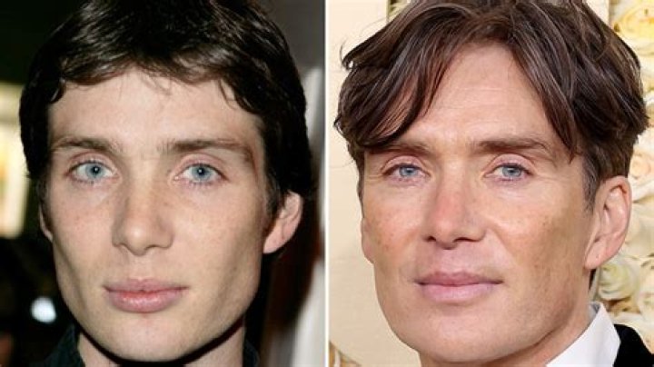 Cillian Murphy Plastic Surgery Fans Suspect Botox Before After