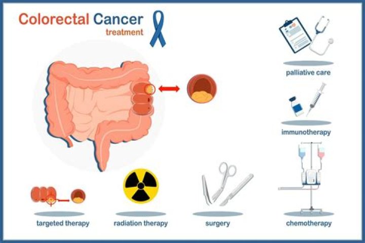 Colon Cancer treatment ChemoExperts