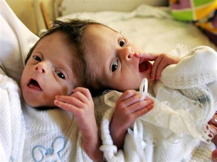 Conjoined twins 40 amazing photos (GRAPHIC IMAGES) Photo 26