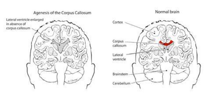 Corpus Callosum What Is It, Location, Function, and More Osmosis