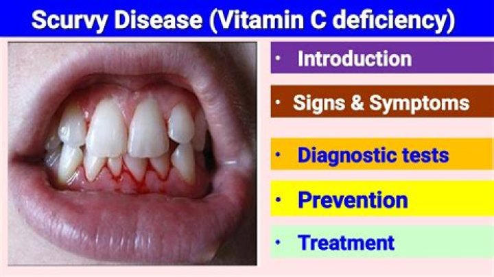 Cureus Scurvy A Diagnosis Not to Be Missed