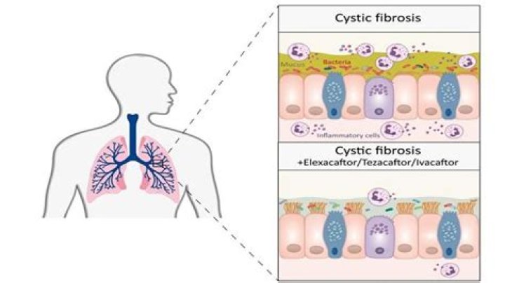 Cystic fibrosis in retreat, but still unbeaten CHEST Physician