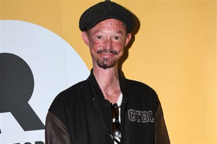 Darren Kent illness What Skin Disorder Did Darren Kent Have?