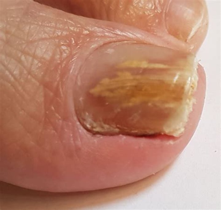 DFP Literaturstudium Dermato und Onychomykosen Diagnose und
