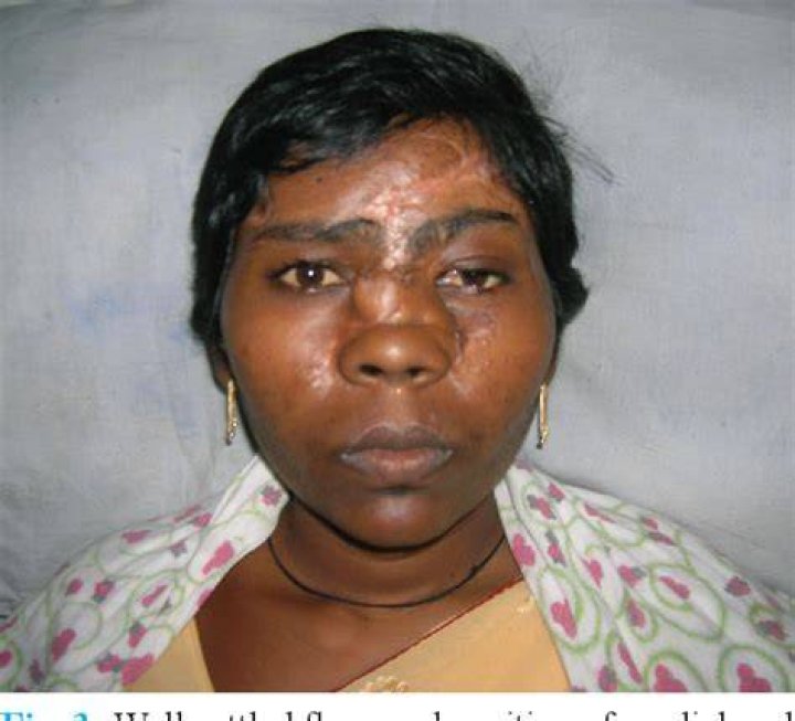 Figure 2 from Face Avulsion and Degloving Semantic Scholar