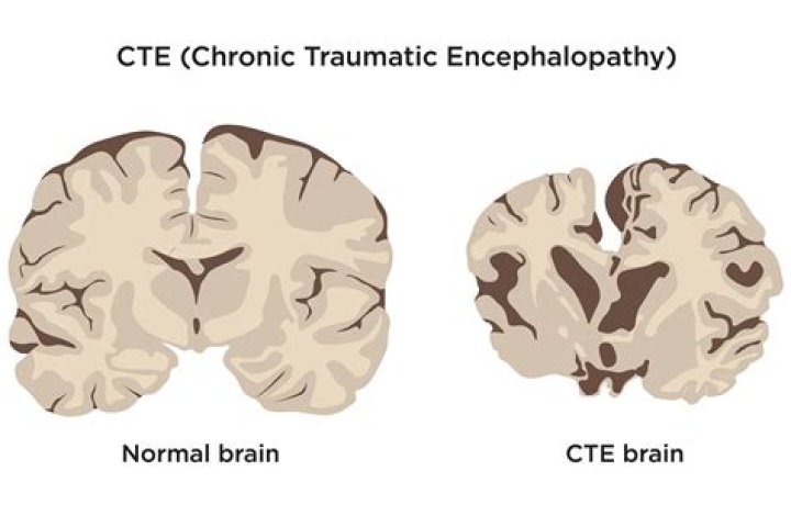 Frank Gifford CTE diagnosis revealed by family