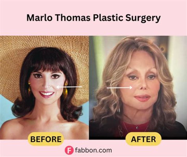 Has Marlo Thomas Had Plastic Surgery? Actress’ Photos From ‘That Girl
