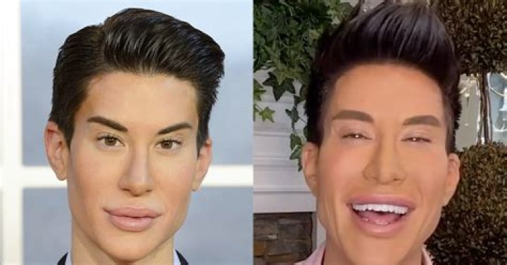 Human Ken Doll Is Back! Hear All About His 900+ Cosmetic Surgeries in