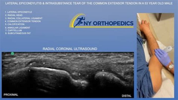 Intrasubstance Tear of the Right Rotator Cuff Medical Illustrations
