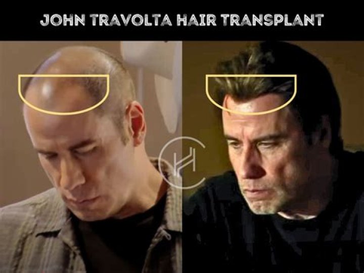 John Travolta Has Shaved His Head Now