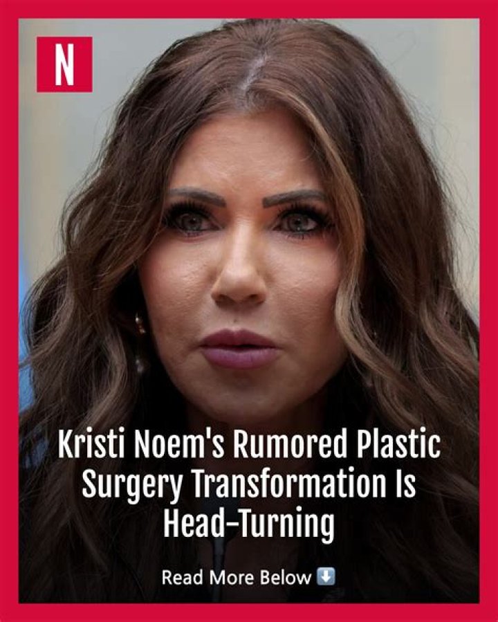 Kristi Noem Plastic Surgery Inside Her Plastic Surgery Procedures