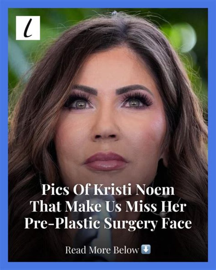 Kristi Noem&rsquo;s Plastic Surgery Couldn&rsquo;t Be More Obvious to Viewers in