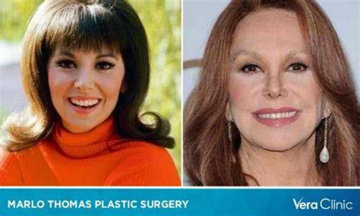 Marlo Thomas Botox Before And After Photos Did She Have A Facelift?