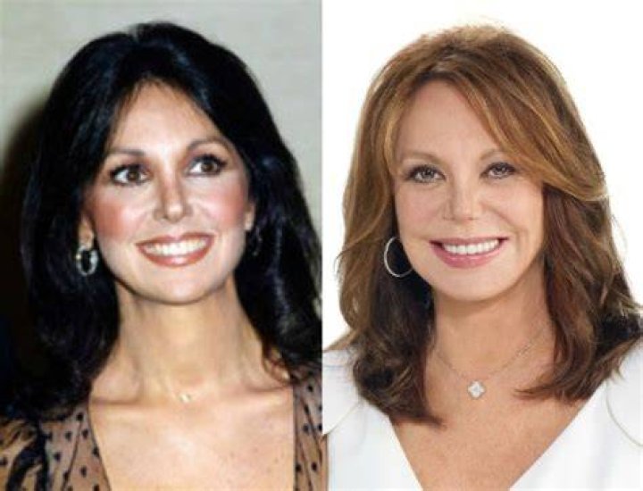 Marlo Thomas Plastic Surgery Before and After Facelift Star Plastic