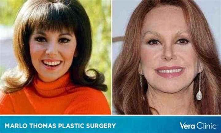 Marlo Thomas Plastic Surgery Plastic Surgery Feed
