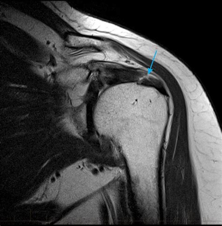 Mri Shoulder Supraspinatus Tendon Tear Mri At Melbour vrogue.co