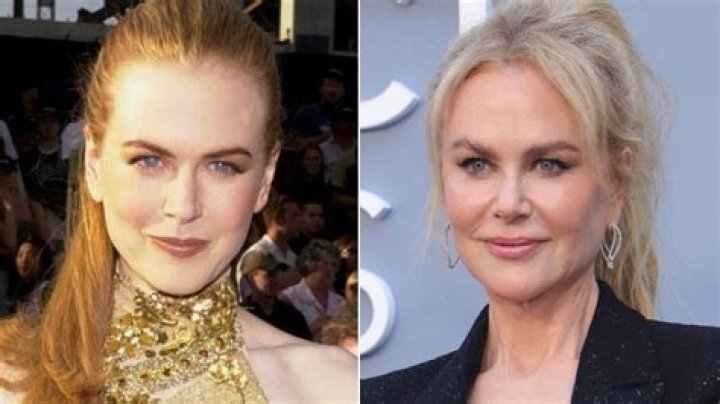 Nicole Kidman Botox Was An Unfortunate Move But Now I Can Move My Face