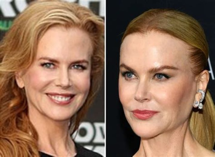 Nicole Kidman Gets a Facelift? Our Plastic Surgery Experts Weigh In
