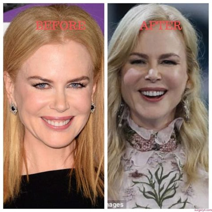 Nicole Kidman Plastic Surgery Photos [Before & After] Surgery4