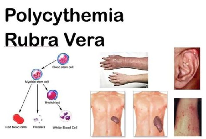 Phyllis Dies From Polycythemia Vera Complications PV Reporter