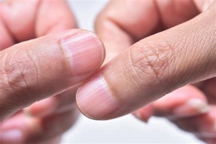 Ridges in fingernails What It Means if You Have Them Reader's Digest