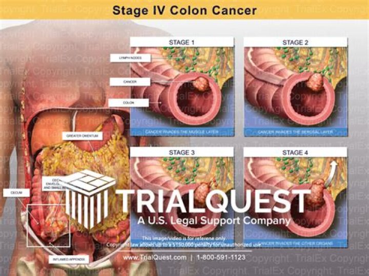 Stage IV Colon Cancer Trial Exhibits Inc.