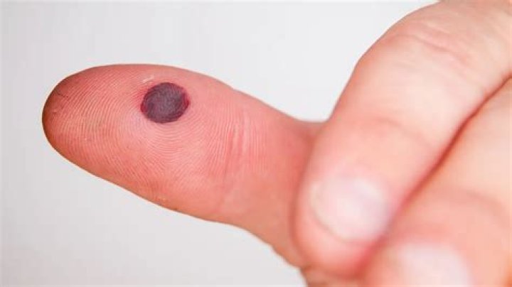What Causes Blood Blisters?