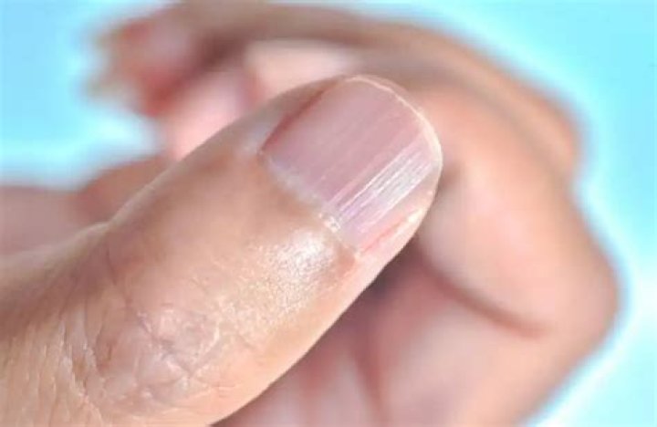What Do Ridges In Your Nails Mean (2023)