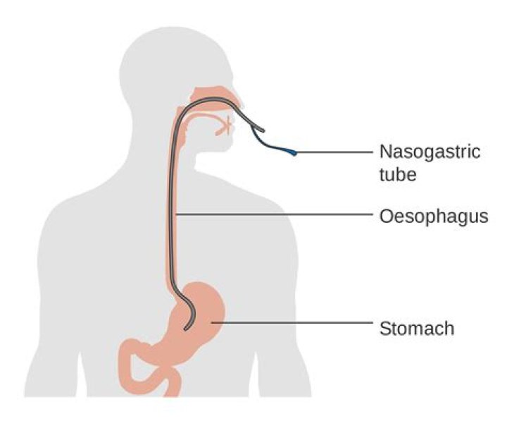 What is a Nasogastric Tube? (with pictures)