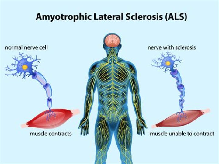 What is Amyotrophic Lateral Sclerosis? Stephen Hawking's Disease Explained Newsweek